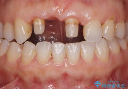 外れやすい前歯のブリッジ　しっかりとした治療を受けたいの治療中