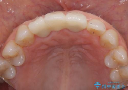 外れやすい前歯のブリッジ しっかりとした治療を受けたいの治療後