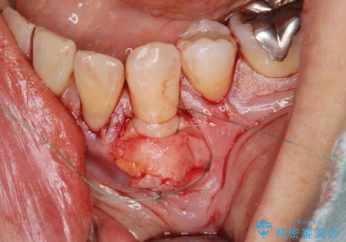 [ 根面被覆 ]  歯ぐきのさがりを移植で改善の治療前