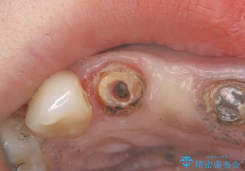 外れやすい前歯のブリッジ　しっかりとした治療を受けたいの治療前