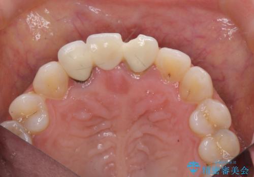 外れやすい前歯のブリッジ しっかりとした治療を受けたいの治療前