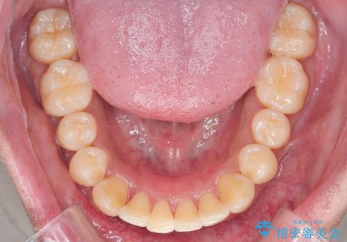 がたつきが気になる。インビザラインでスッキリ。の治療後