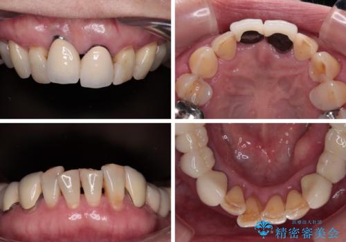 【海外から通院】統一感のない前歯をきれいに　オールセラミッククラウン治療の治療前