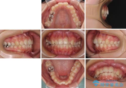 【モニター】デコボコとクロスバイトの前歯 ワイヤー装置での抜歯矯正の治療前