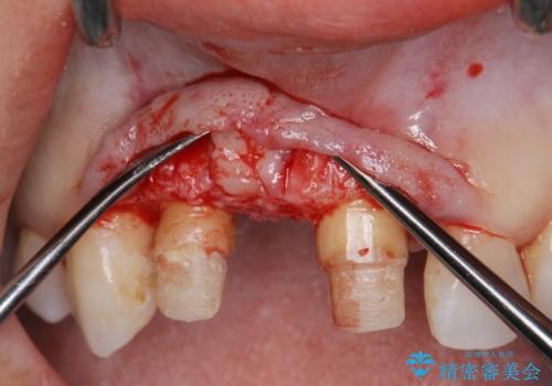 外れやすい前歯のブリッジ しっかりとした治療を受けたいの治療中