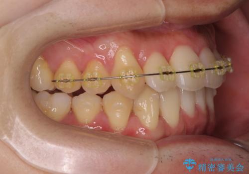 ねじれ・がたつきのある前歯を改善の治療中