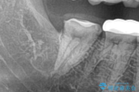 親知らずを抜いてほしいの治療後