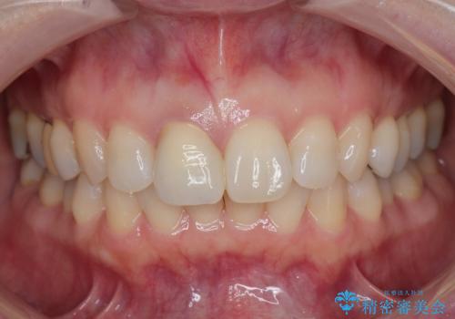 前歯の色が気になる。の治療後