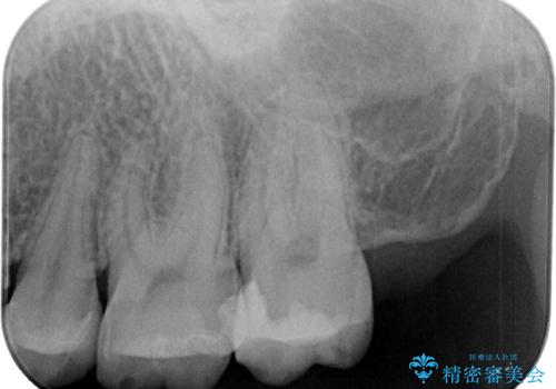 詰め物が欠けたのでやり替えたい セラミックインレー修復の治療後