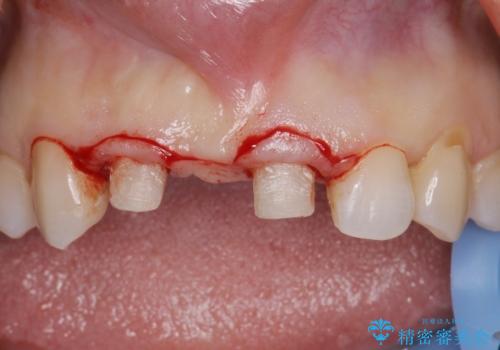 外れやすい前歯のブリッジ しっかりとした治療を受けたいの治療中