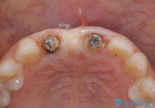 外れやすい前歯のブリッジ しっかりとした治療を受けたいの治療前