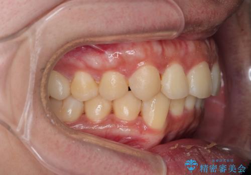 がたつきが気になる。インビザラインでスッキリ。の治療後