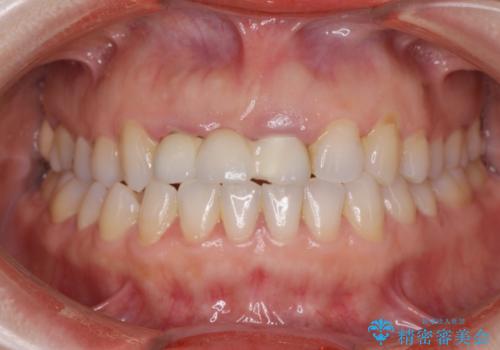外れやすい前歯のブリッジ　しっかりとした治療を受けたいの治療前