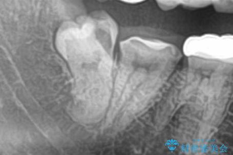 親知らずを抜いてほしいの治療前