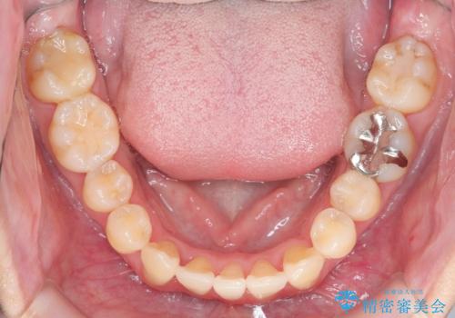 ねじれ・がたつきのある前歯を改善の治療後