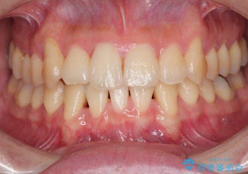 ねじれ・がたつきのある前歯を改善の治療後