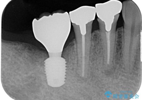 他院で抜歯をしたのでインプラントを入れたい　インプラント治療の治療後