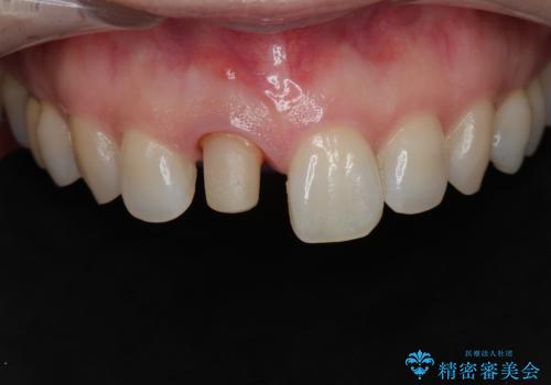 前歯の色が気になる。の治療中