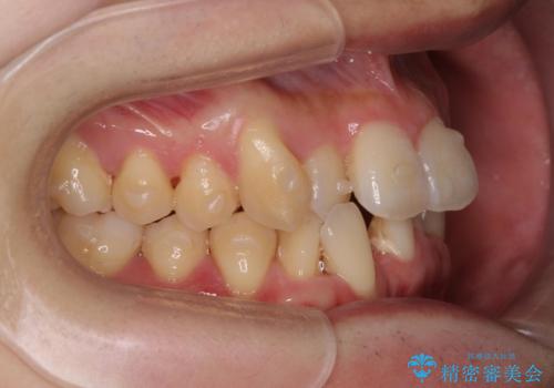 ねじれ・がたつきのある前歯を改善の治療前
