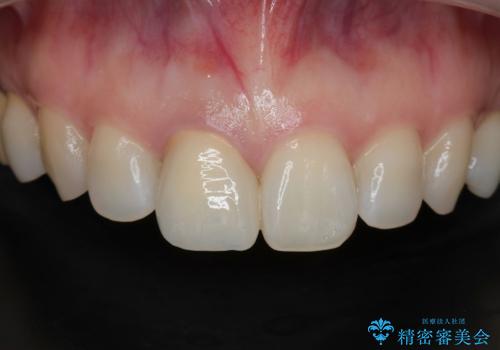 前歯の色が気になる。の治療後