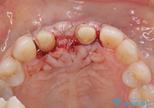 外れやすい前歯のブリッジ しっかりとした治療を受けたいの治療後