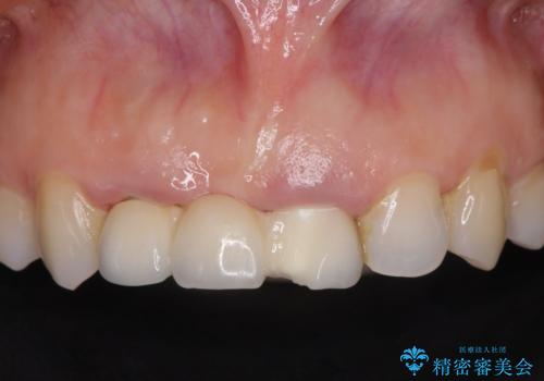 外れやすい前歯のブリッジ　しっかりとした治療を受けたいの治療前