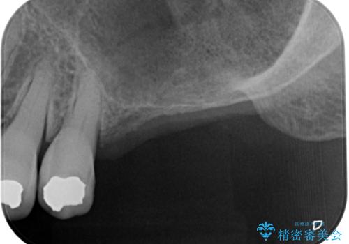 骨量の少ない上顎大臼歯　骨補填材を用いない短期間インプラント治療の治療前