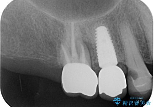 破折して抜歯となった奥歯　抜歯即時埋入・即時荷重インプラントによる補綴治療の治療前