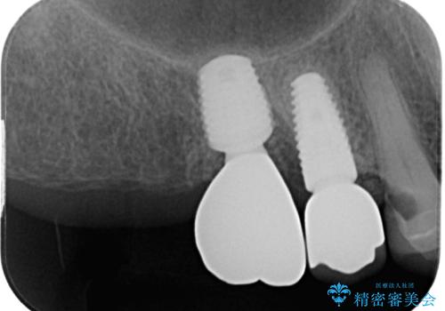 破折して抜歯となった奥歯 抜歯即時埋入・即時荷重インプラントによる補綴治療の治療後