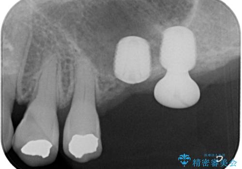 骨量の少ない上顎大臼歯 骨補填材を用いない短期間インプラント治療の治療中