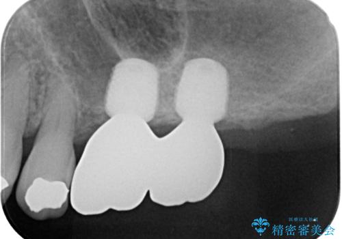 骨量の少ない上顎大臼歯 骨補填材を用いない短期間インプラント治療の治療後
