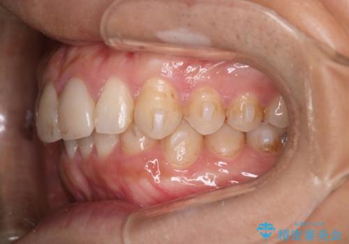 【インビザラインとセラミック】前歯を綺麗にの治療中