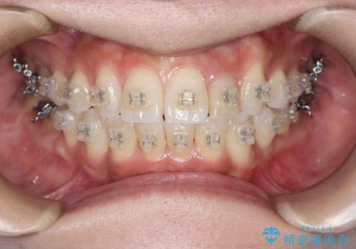 矯正中でも艶々になるクリーニングの治療前