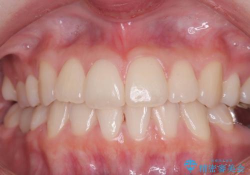 短期間で清潔感のある白い歯への治療前