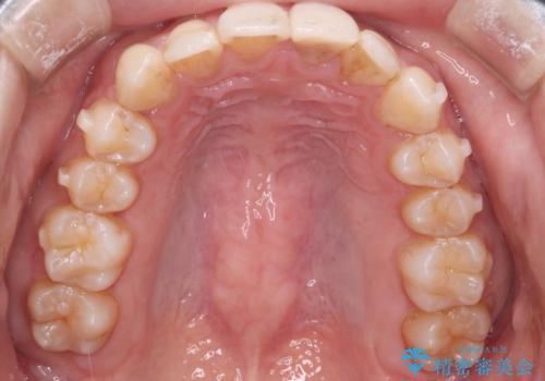 【インビザラインとセラミック】前歯を綺麗にの治療中