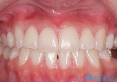 短期間で清潔感のある白い歯への症例 治療後