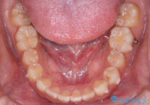 【インビザラインとセラミック】前歯を綺麗にの治療中