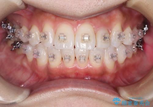 矯正中でも艶々になるクリーニングの治療後