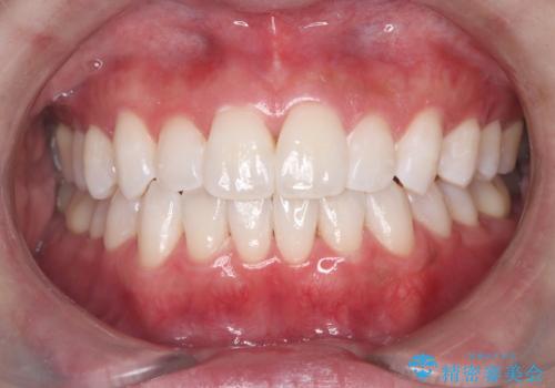 数年ぶりのホワイトニング