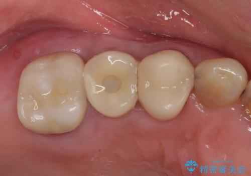 破折して抜歯となった奥歯　抜歯即時埋入・即時荷重インプラントによる補綴治療の治療前