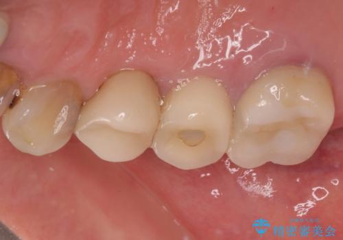 破折して抜歯となった奥歯 抜歯即時埋入・即時荷重インプラントによる補綴治療の治療前