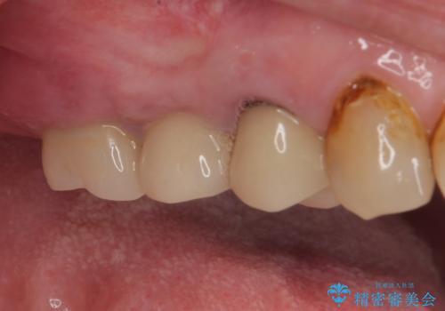 破折して抜歯となった奥歯 抜歯即時埋入・即時荷重インプラントによる補綴治療の治療前