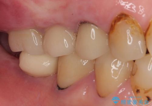 破折して抜歯となった奥歯 抜歯即時埋入・即時荷重インプラントによる補綴治療の治療前