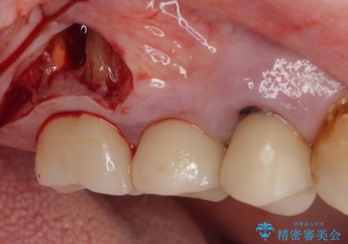 破折して抜歯となった奥歯　抜歯即時埋入・即時荷重インプラントによる補綴治療