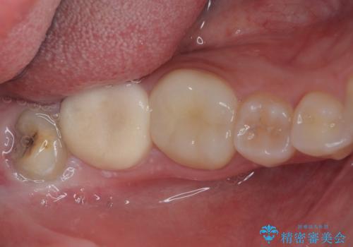 親知らずを抜いてほしいの治療前