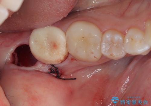 親知らずを抜いてほしいの治療後