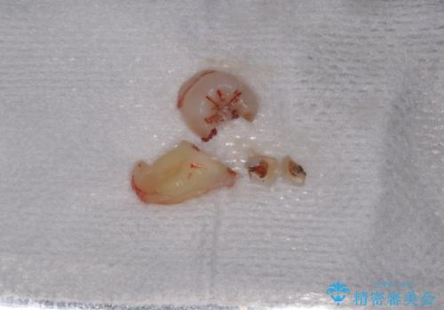 親知らずを抜いてほしいの治療中