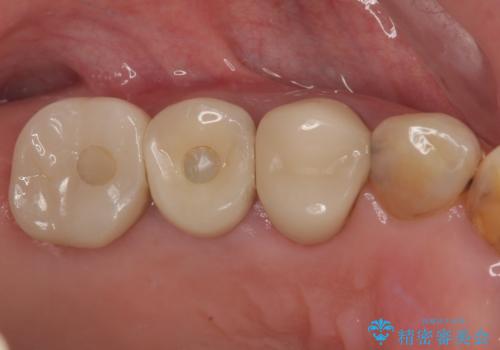 破折して抜歯となった奥歯 抜歯即時埋入・即時荷重インプラントによる補綴治療の治療後