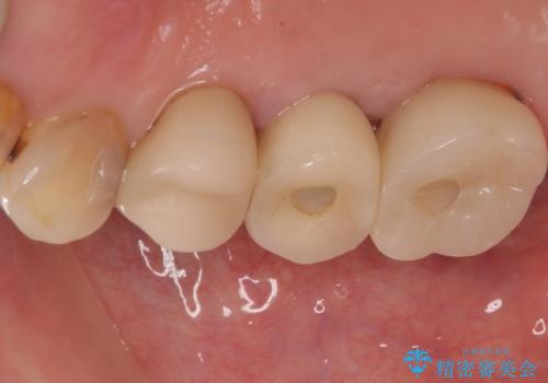 破折して抜歯となった奥歯　抜歯即時埋入・即時荷重インプラントによる補綴治療の治療後
