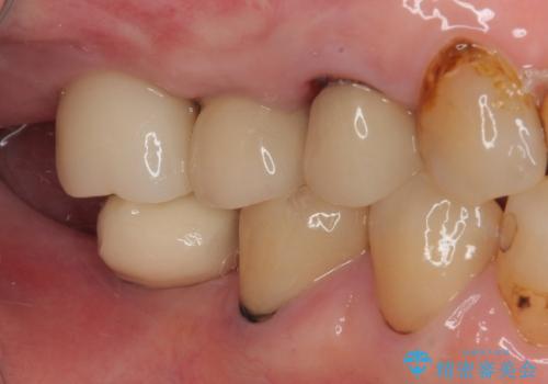 破折して抜歯となった奥歯 抜歯即時埋入・即時荷重インプラントによる補綴治療の治療後